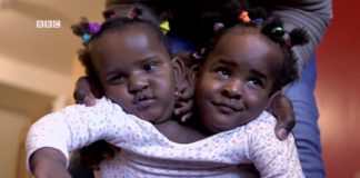 Seront-elles séparées avec succès : Ndèye et Marième, jumelles siamoises sénégalaises