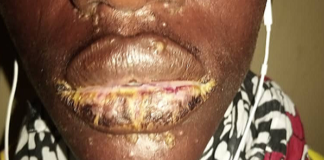 Thiaroye Sur-Mer: une curieuse maladie dermique « émerge » sur de jeunes pêcheurs