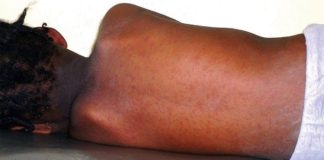 Panique à Guédiawaye: audio annonçant 11 cas de rougeole et, précisions médecin-chef de district