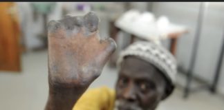 SANTÉ PUBLIQUE : Le Sénégal a enregistré 150 nouveaux cas de lèpre en 2022
