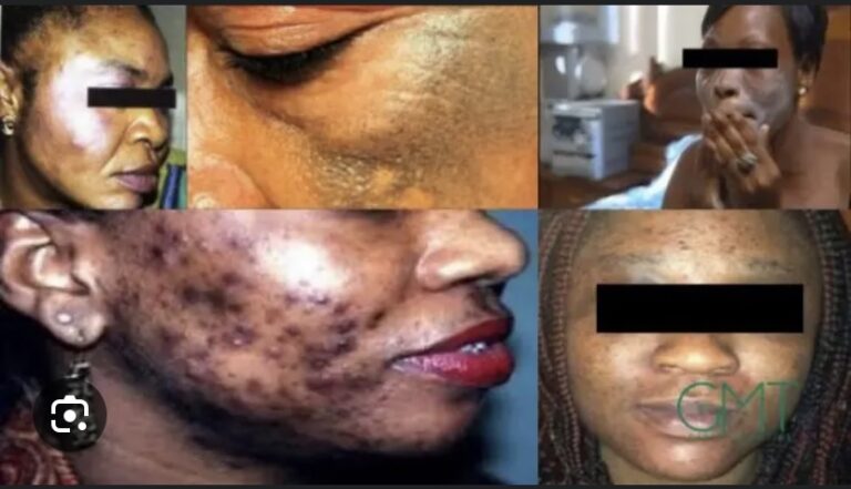 DÉPIGMENTATION VOLONTAIRE ET CANCERS CUTANÉS : ‘Il y’a une mortalité de près de 100% depuis décembre’ selon Dr Fatoumata Ly