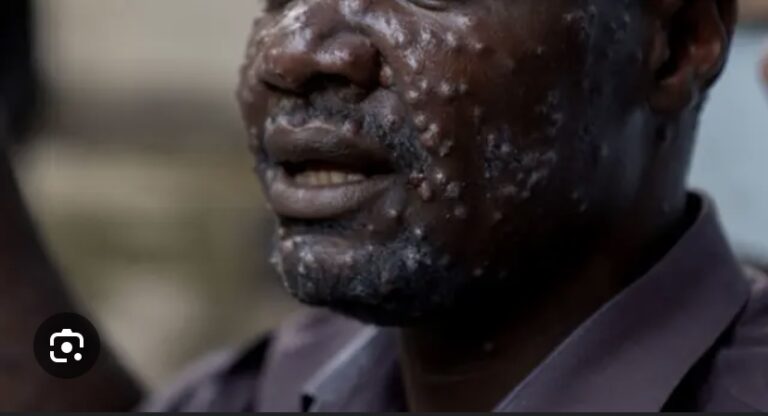 VARIOLE MPOX : Le Sénégal active son Centre des opérations d’urgence sanitaire